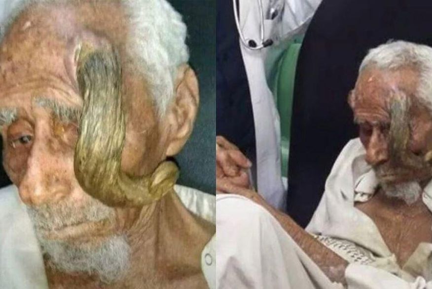 Homem que teria 140 anos morre após cirurgia para retirar ‘chifres’